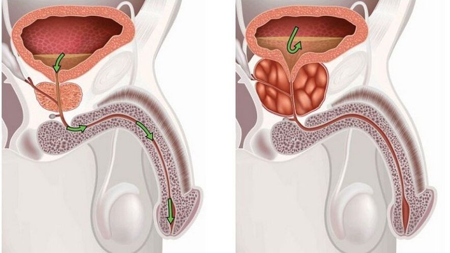 Prostatitis férfiakban